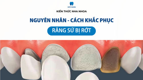 Răng sứ bị rớt ra ngoài - Nguyên nhân và cách xử lý